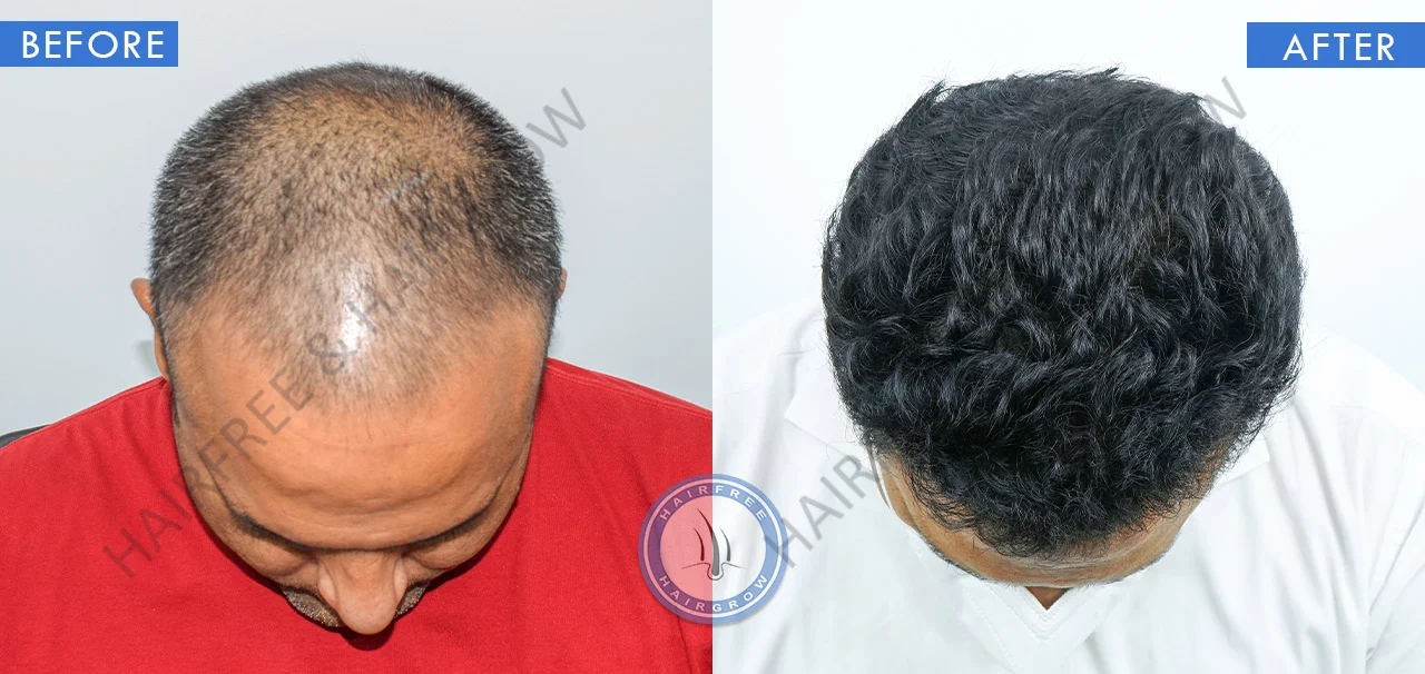 hair-transplant-best-result