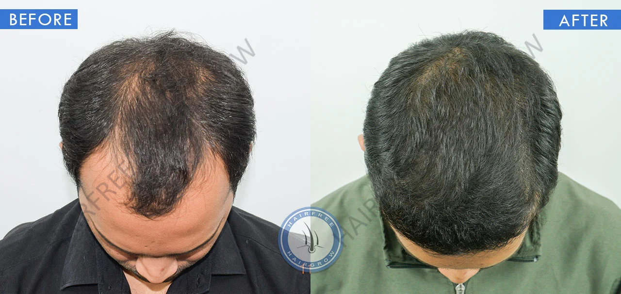 hair-transplant-top-view-before-after