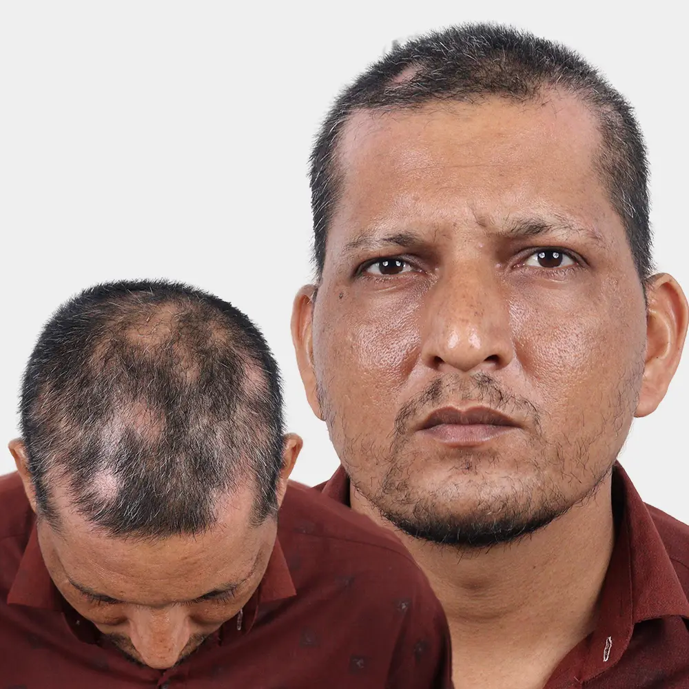 alopecia-areata