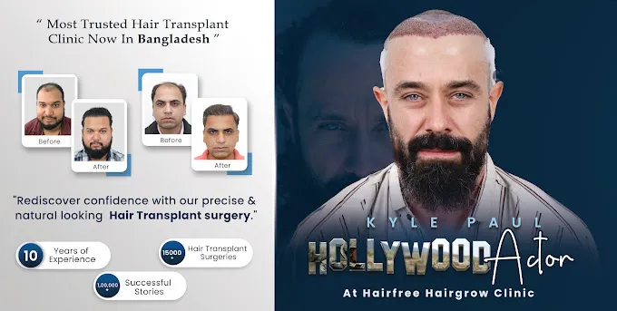 kyle-paul-hair-transplant-result-in-hair-free-hair-grow-clinic