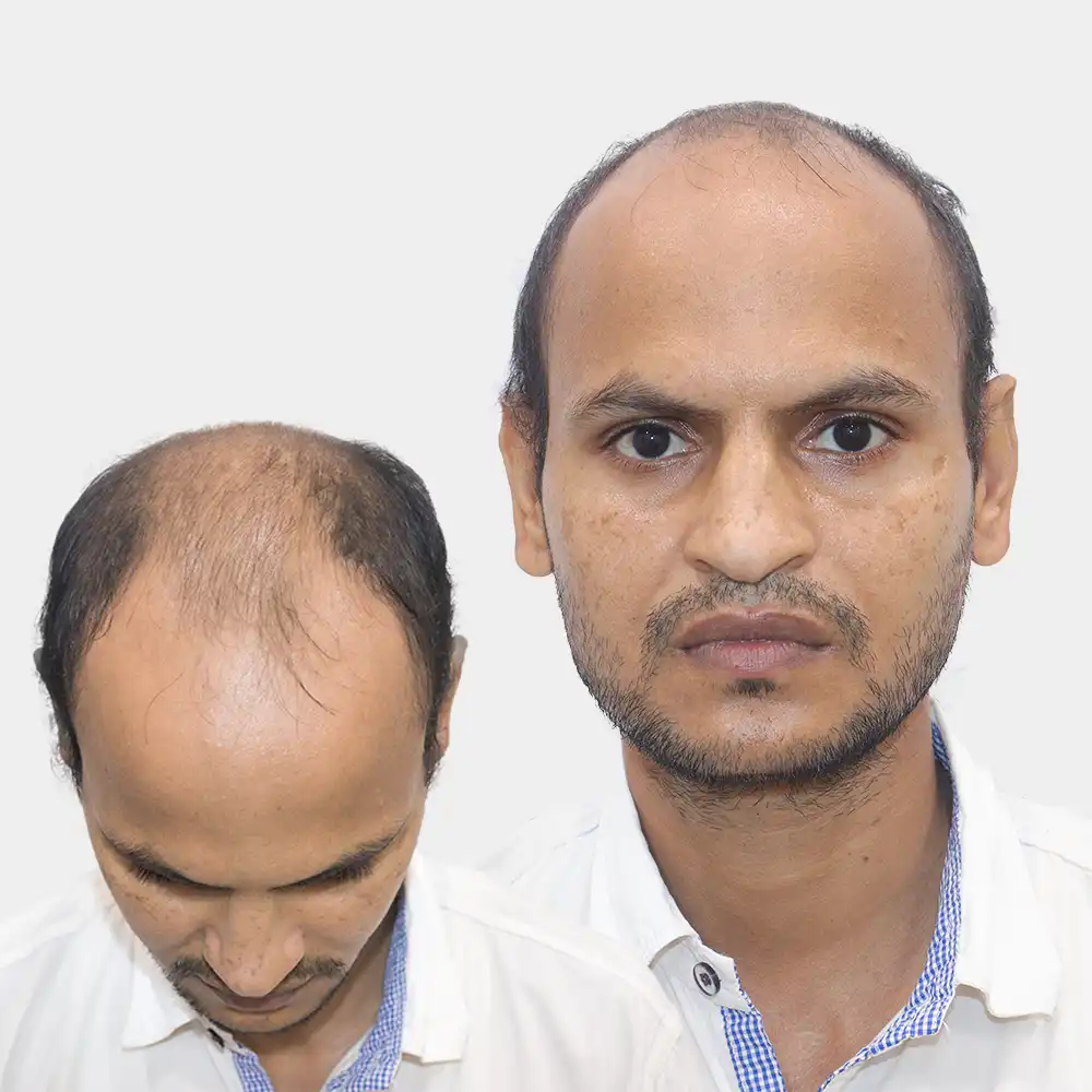 known-as-male-pattern-baldness