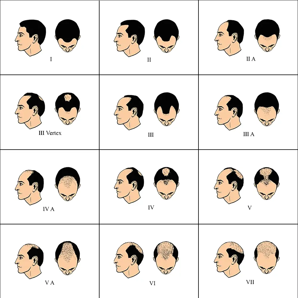 male-pattern-hair-loss