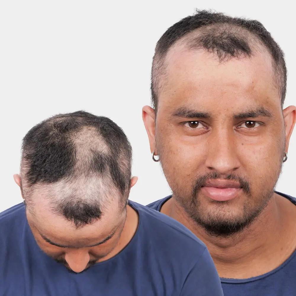 non-cicatricial-alopecia