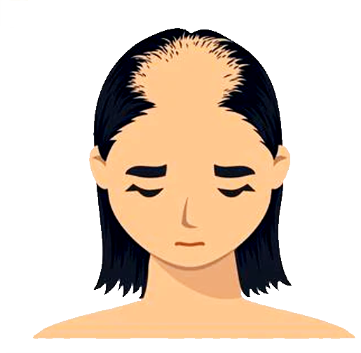 stage-4-female-pattern-baldness