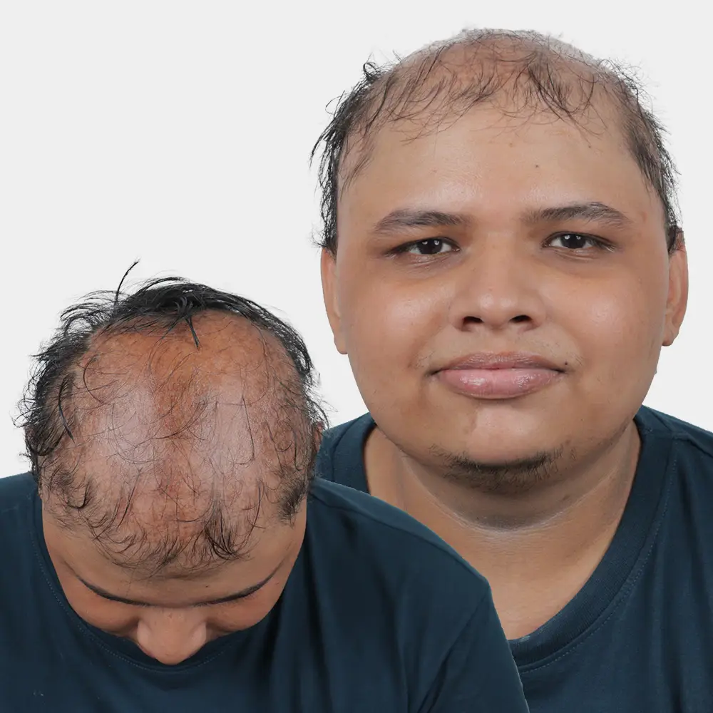 Trichotillomania