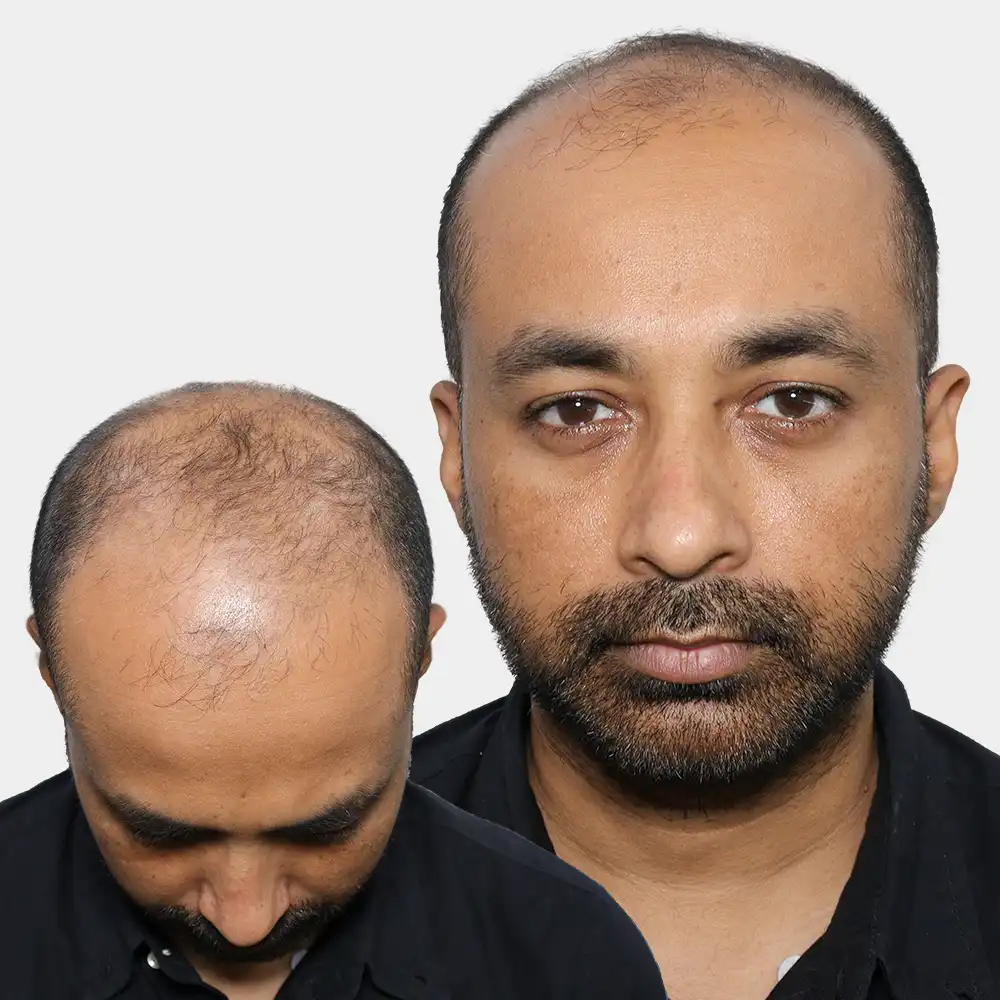 alopecia-or-baldness