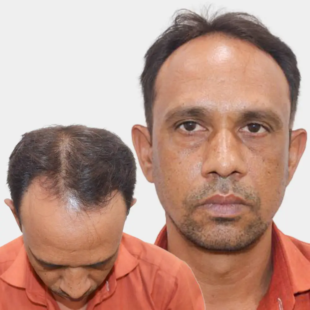 androgenic-alopecia