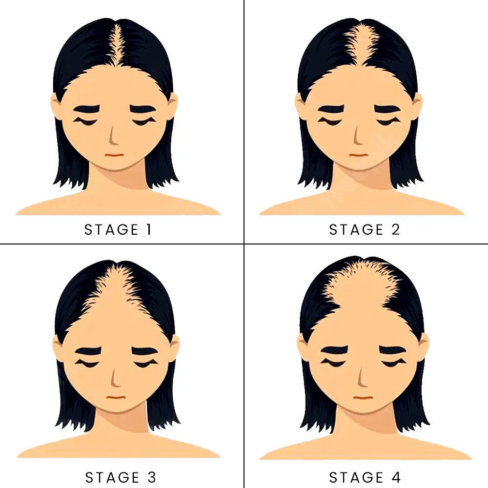 female-pattern-hair-loss