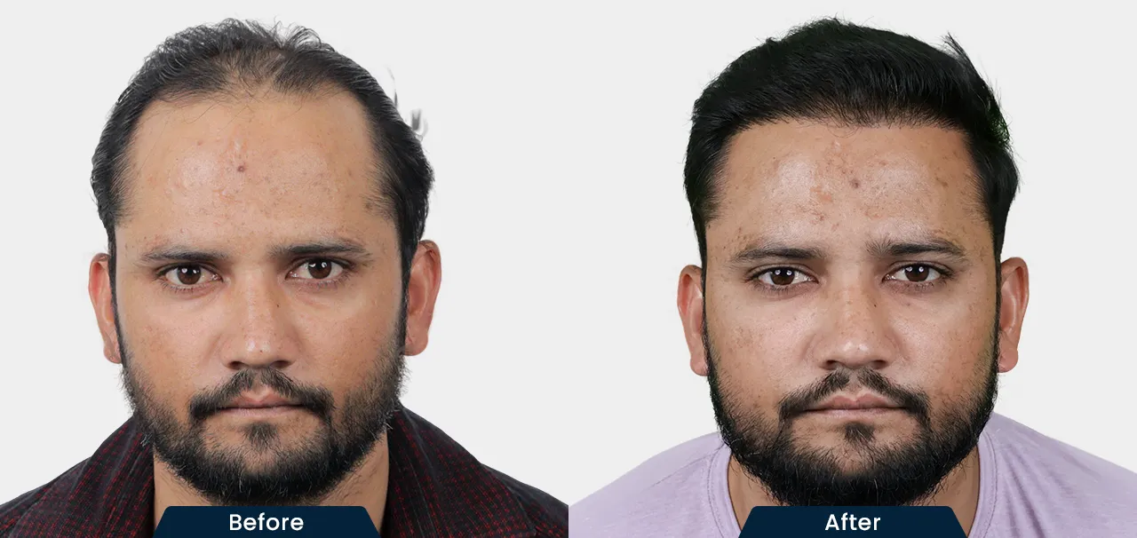 hair-transplant-before-and-after-10