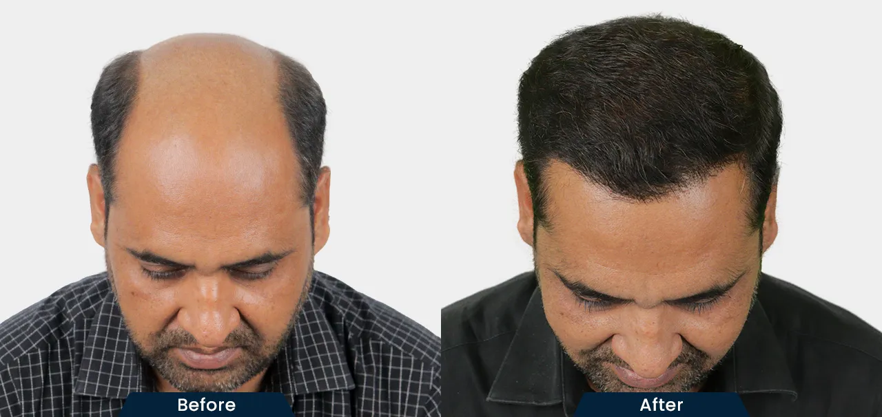 hair-transplant-before-and-after-09