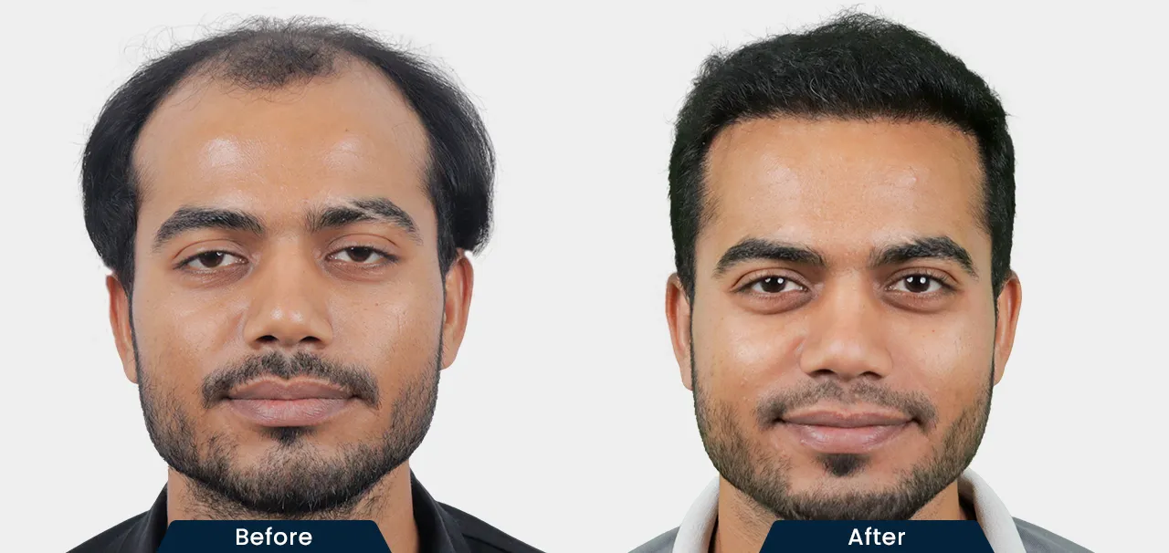 hair-transplant-before-and-after-07