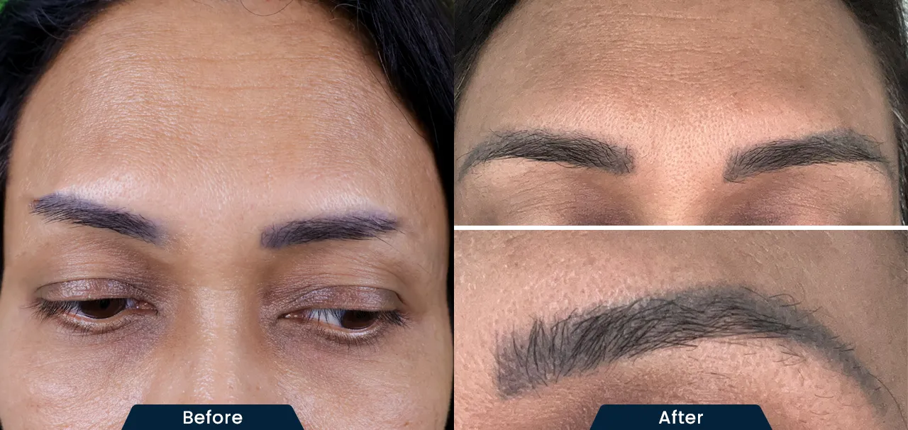 eye-brow-transplant-before-and-after