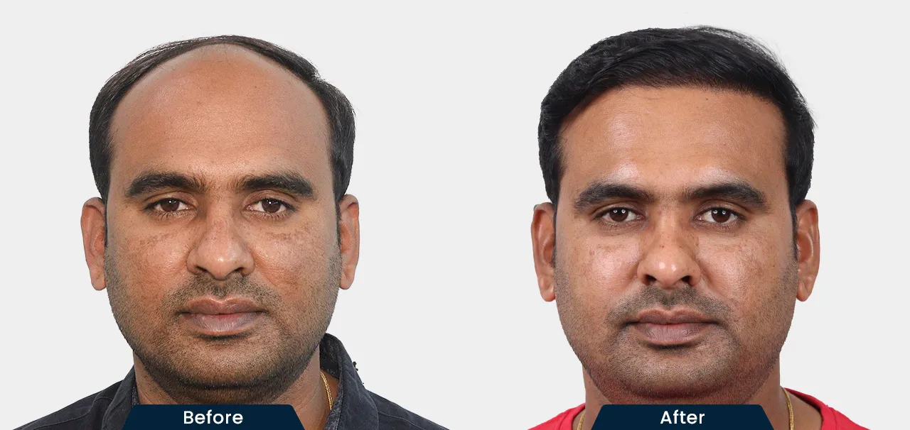 hair-transplant-before-and-after-04