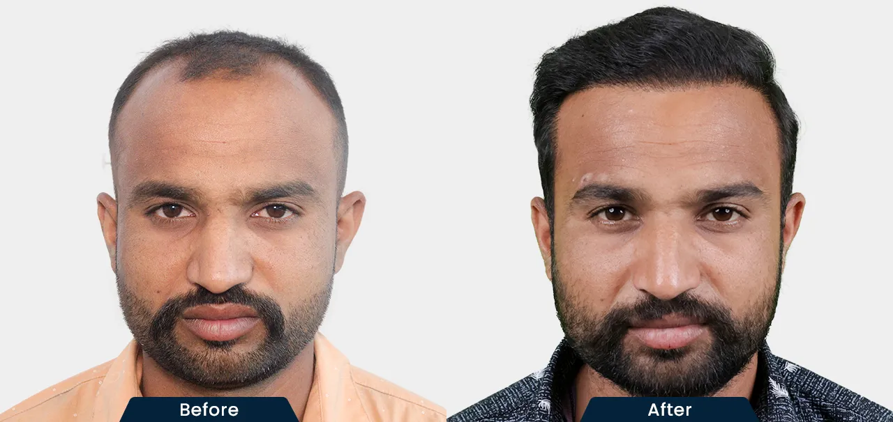 hair-transplant-before-and-after-03