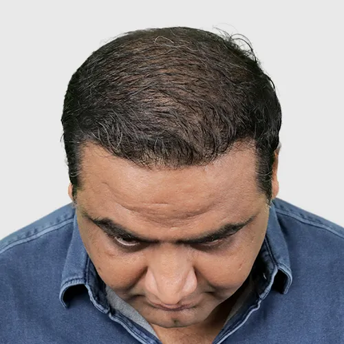 3rd-month-big-fue-result