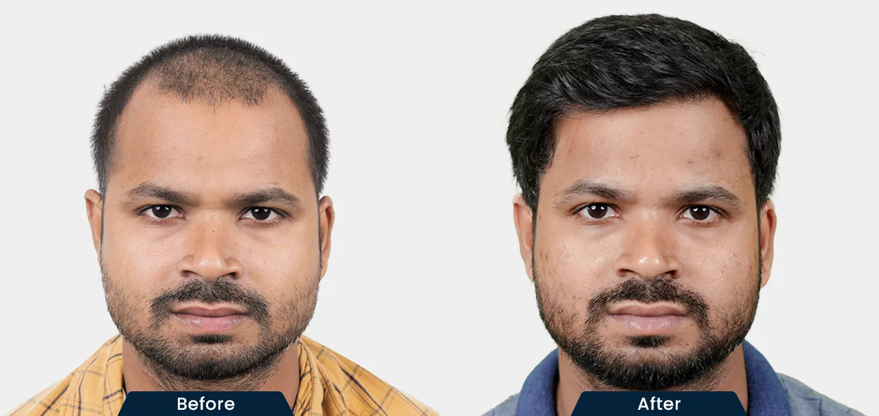 hair-transplant-before-and-after-02