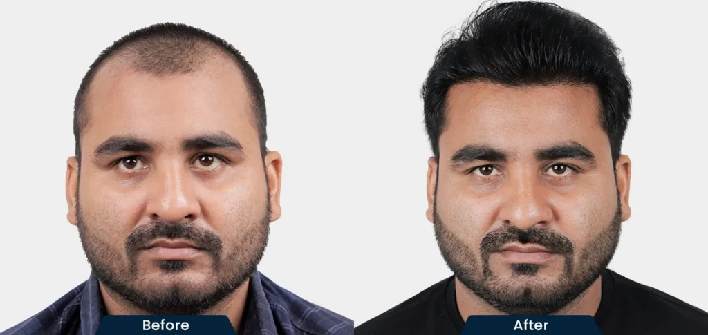 hair-transplant-before-and-after-35