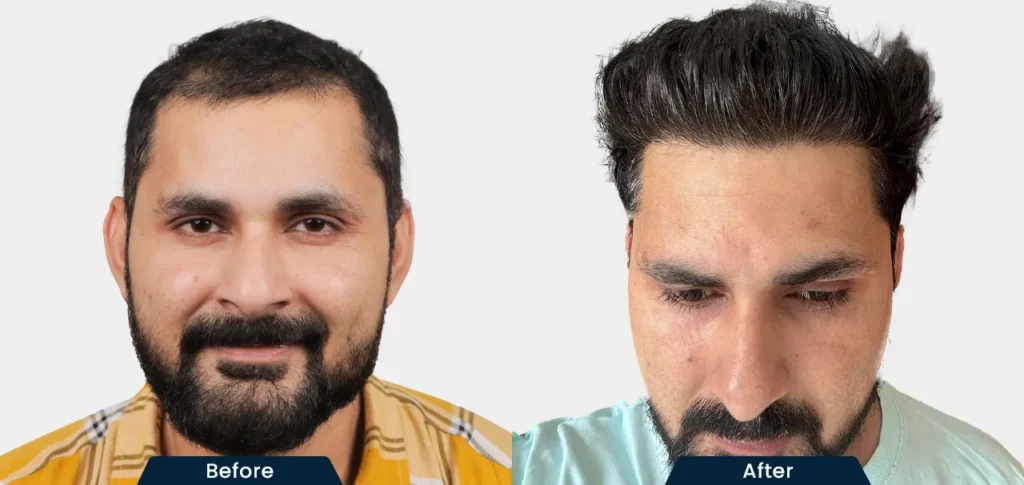 hair-transplant-before-and-after-01