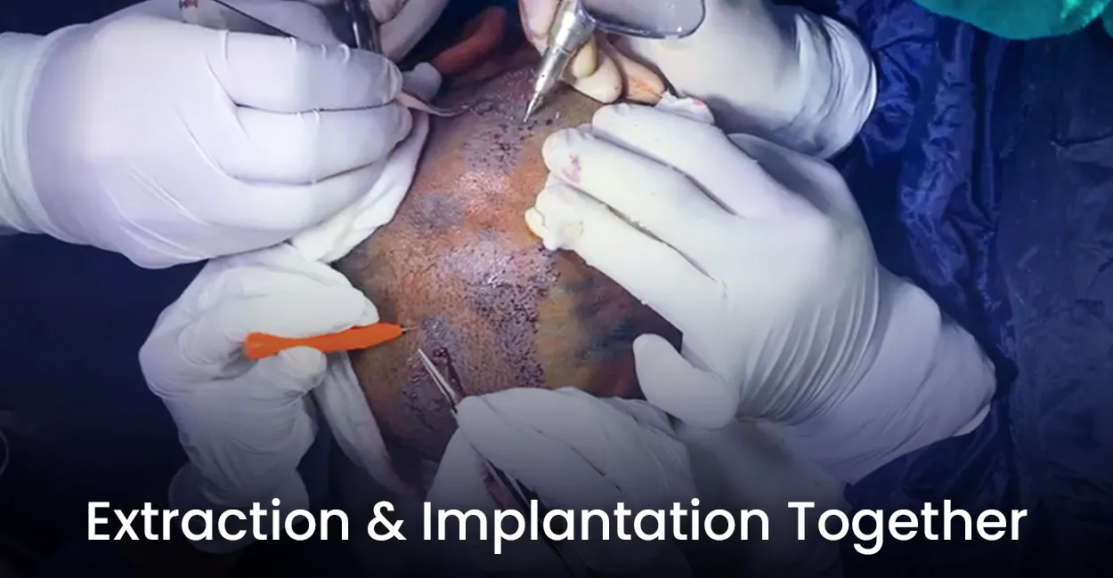 extraction-and-implantation-together