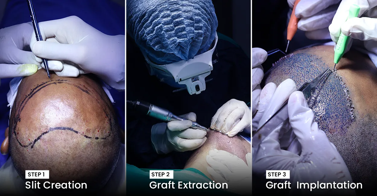 steps-silt-creation-then-graft-extraction-then-graft-implantation