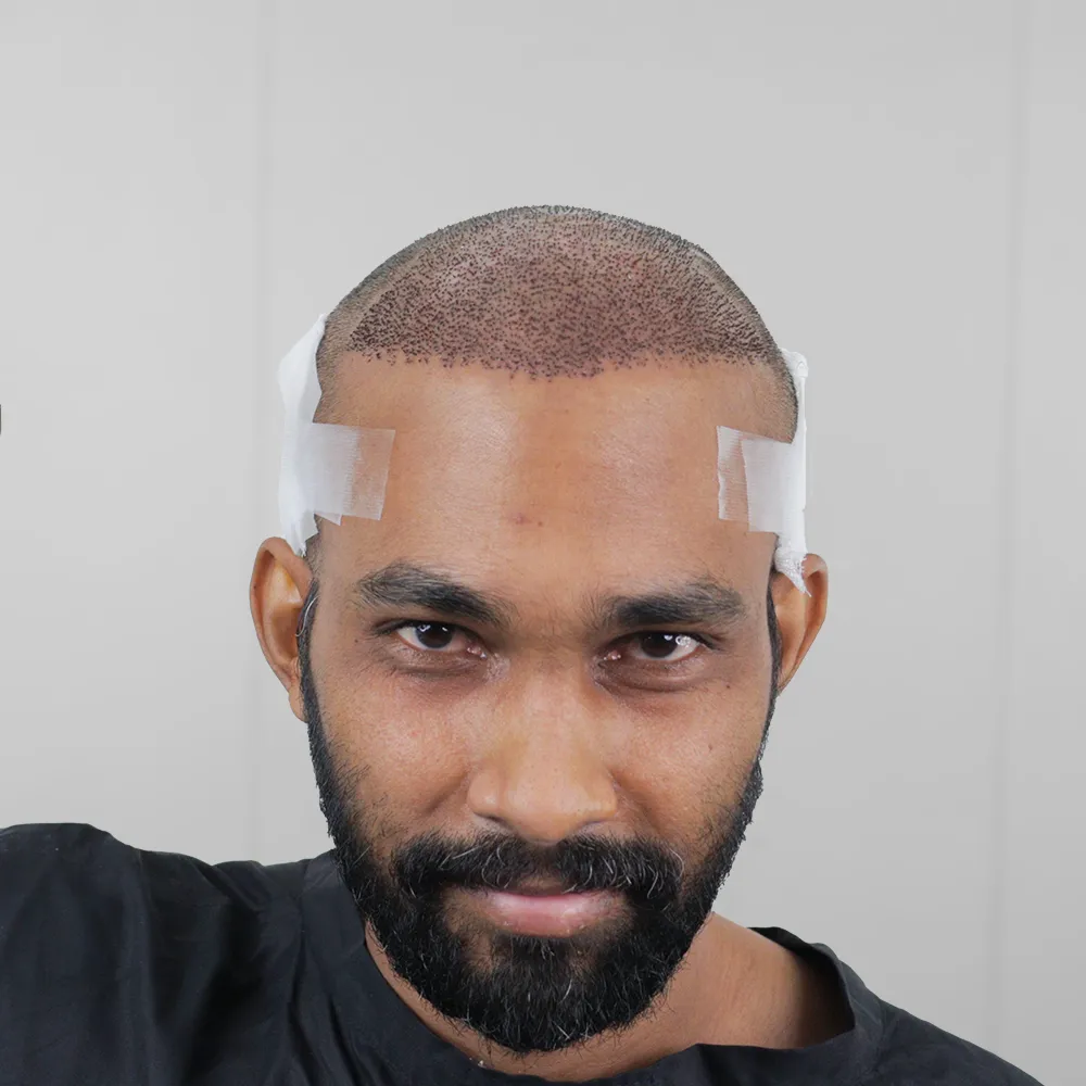 Male Hair transplant