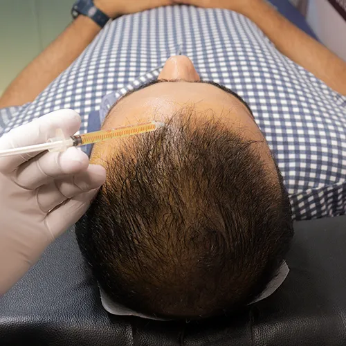 role-of-prp-in-hair-treatment