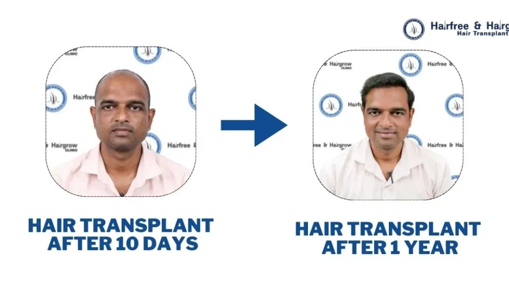 hair-transplant-timeline