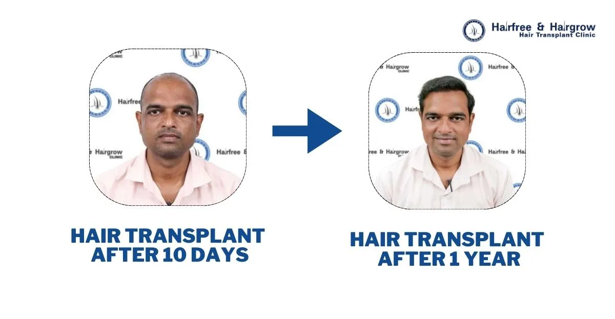 Hair Transplant Timeline: What to Expect at 10 Days, 20 Days, 1 Month, 3 Months, 6 Months, 9 Months & 1 Year