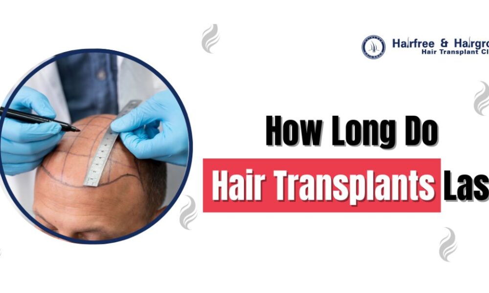 how long do hair transplants last