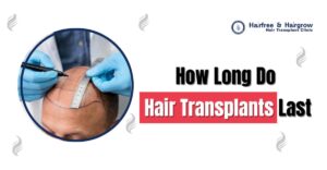 how long do hair transplants last