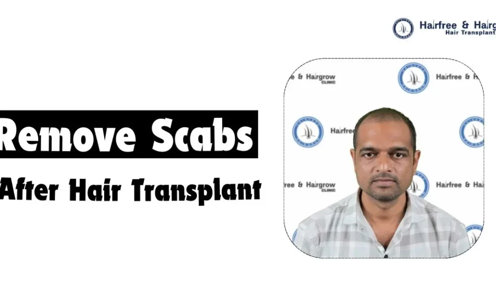how-to-remove-scabs-after-hair-transplant