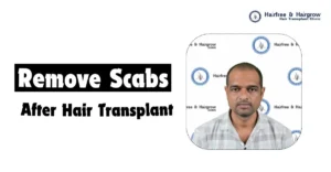 how-to-remove-scabs-after-hair-transplant