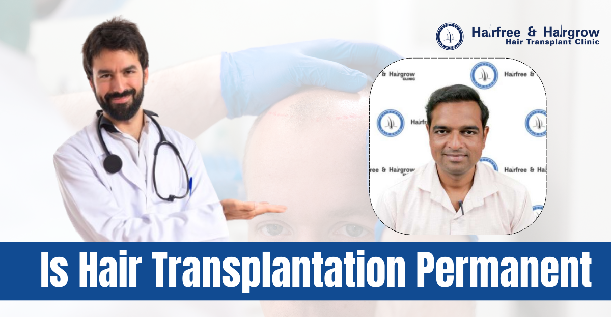 Is Hair Transplantation Permanent?