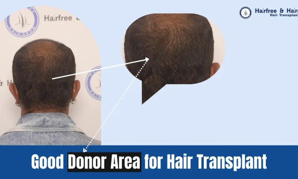 good+donor+area+for+hair+transplant
