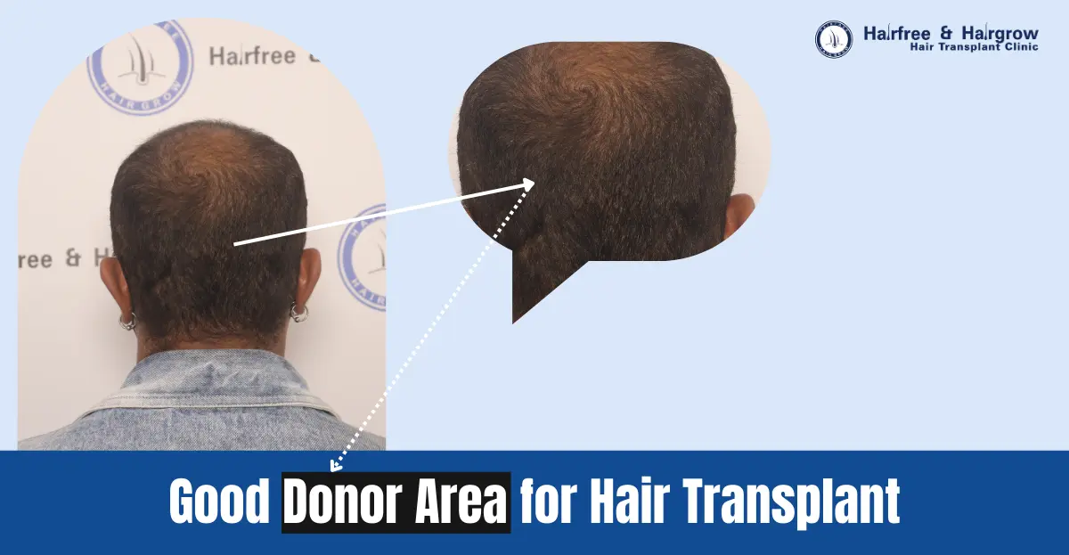 What is a Good Donor Area for Hair Transplant?