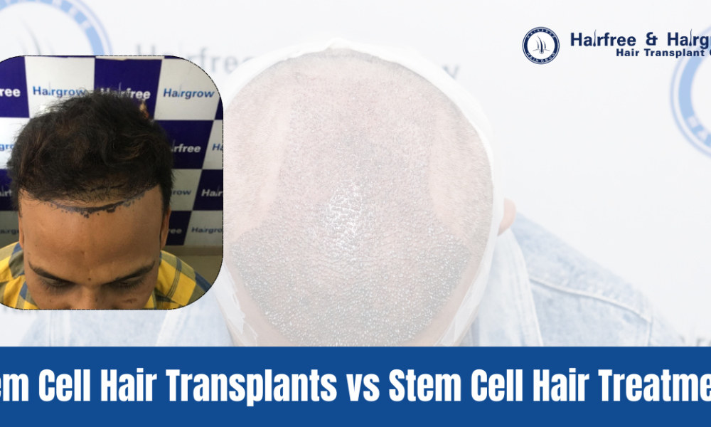 What is Stem Cell Hair Transplant