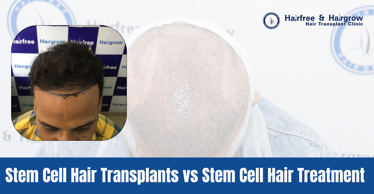 Stem Cell Hair Transplants vs Stem Cell Hair Treatment?