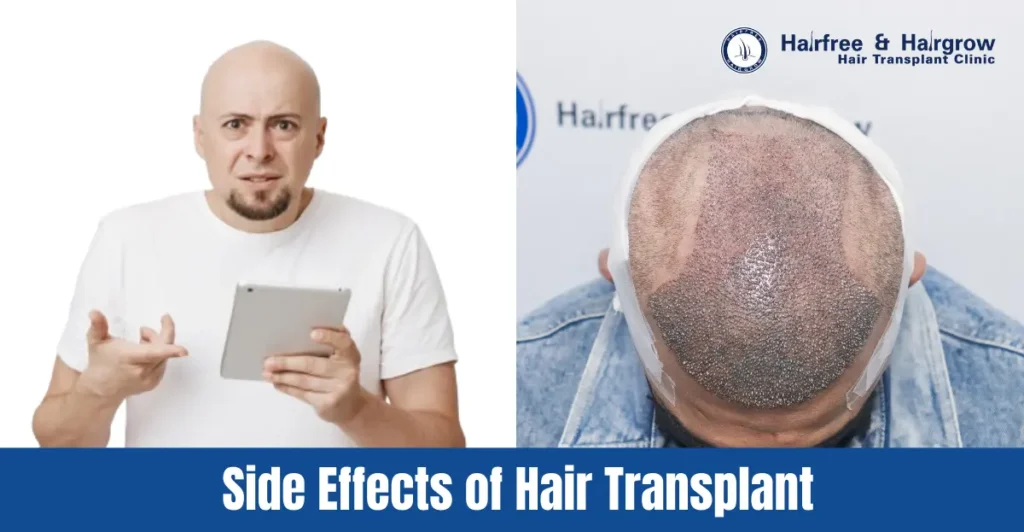 Side Effects of Hair Transplant