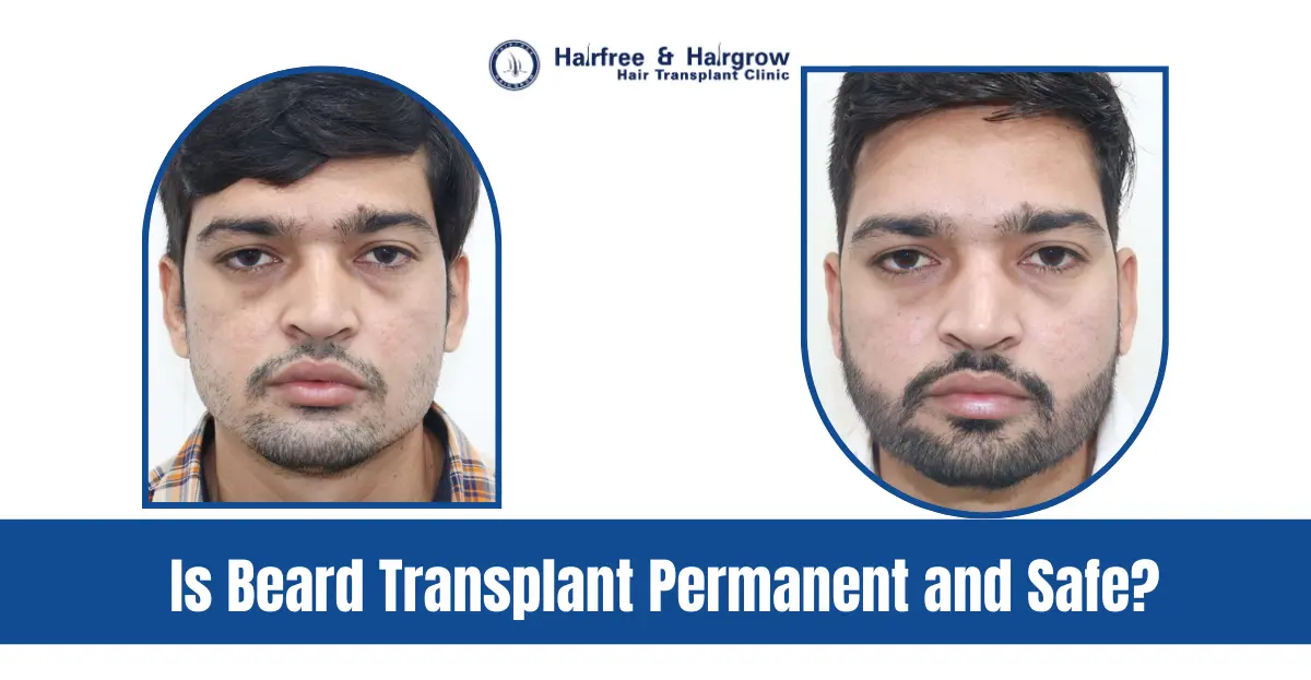 Is Beard Transplant Permanent and Safe