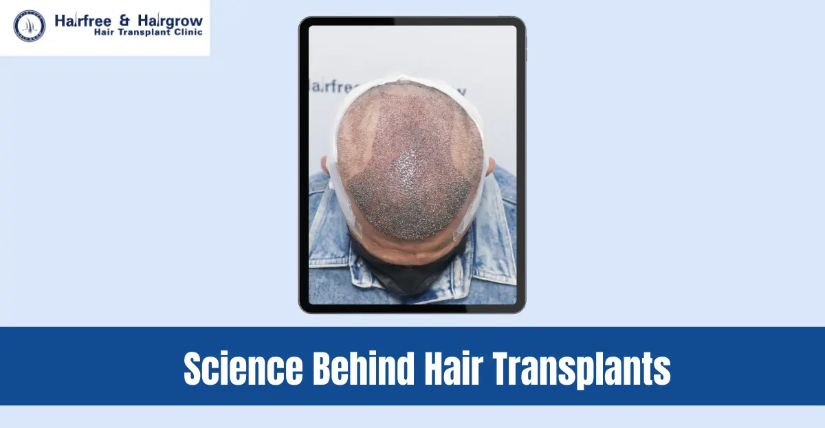 Science+Behind+Hair+Transplants