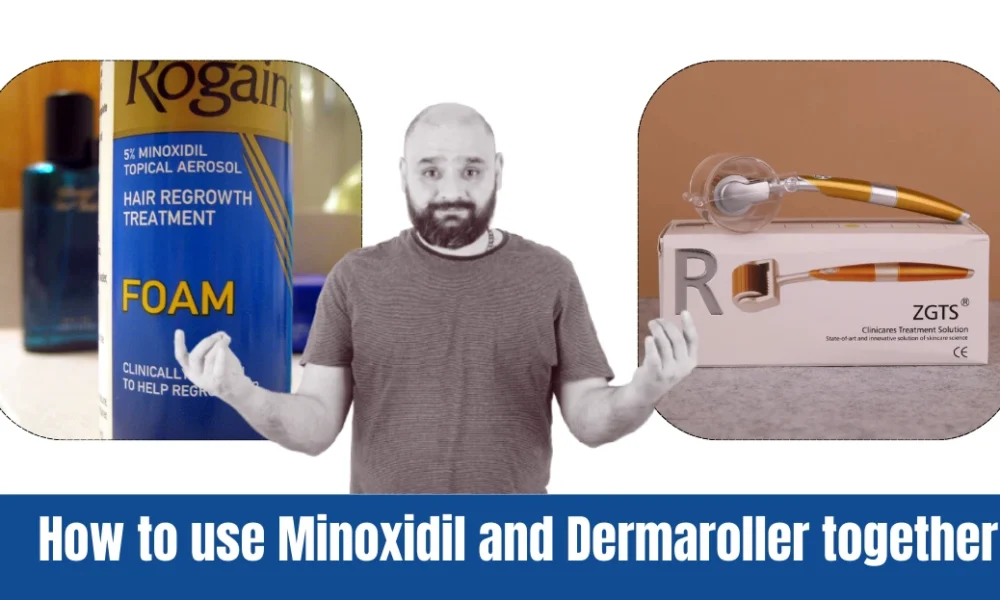 Use Minoxidil and Dermaroller together