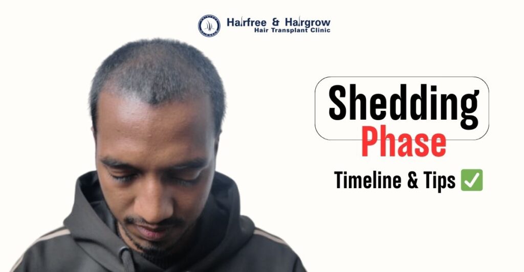 Shedding Phase After Hair Transplant