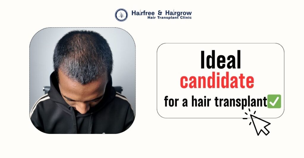 ideal candidate for a hair transplant