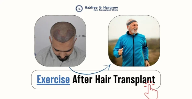 exercise+after+hair+transplant
