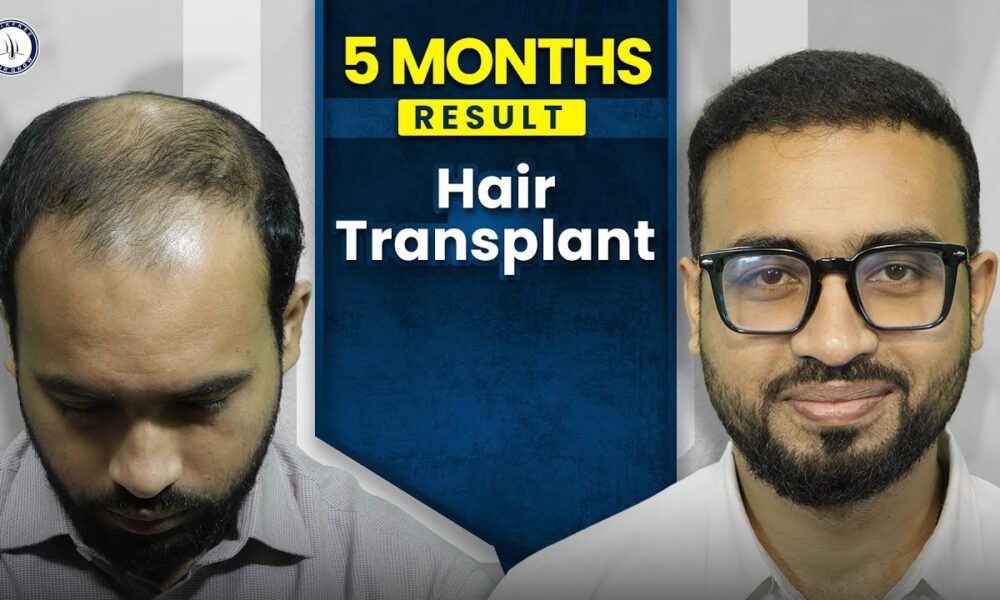 Hair Transplant After 3 Month