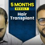 Hair Transplant After 3 Month