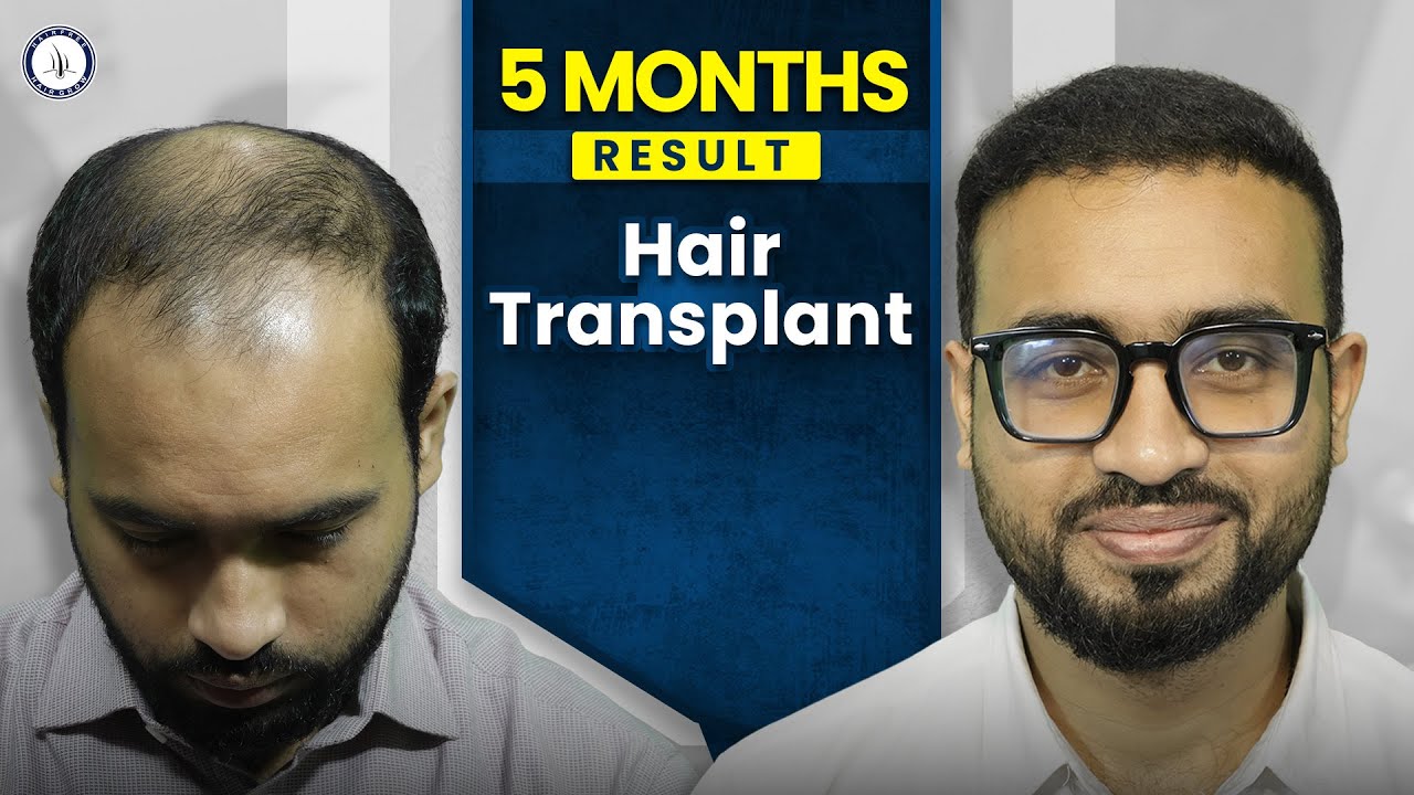 Hair Transplant After 3 Month