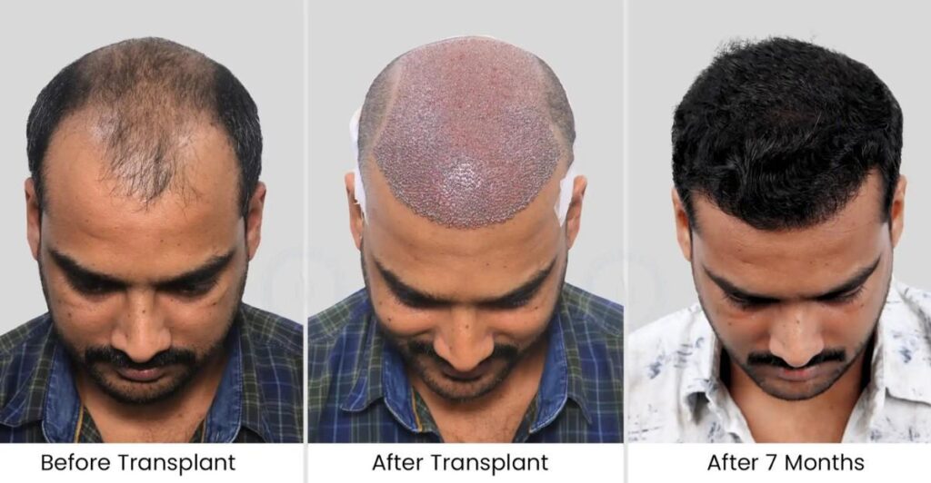 Hair+Transplant+Success+Stories+from+Bangladesh