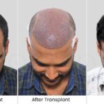 Hair+Transplant+Success+Stories+from+Bangladesh