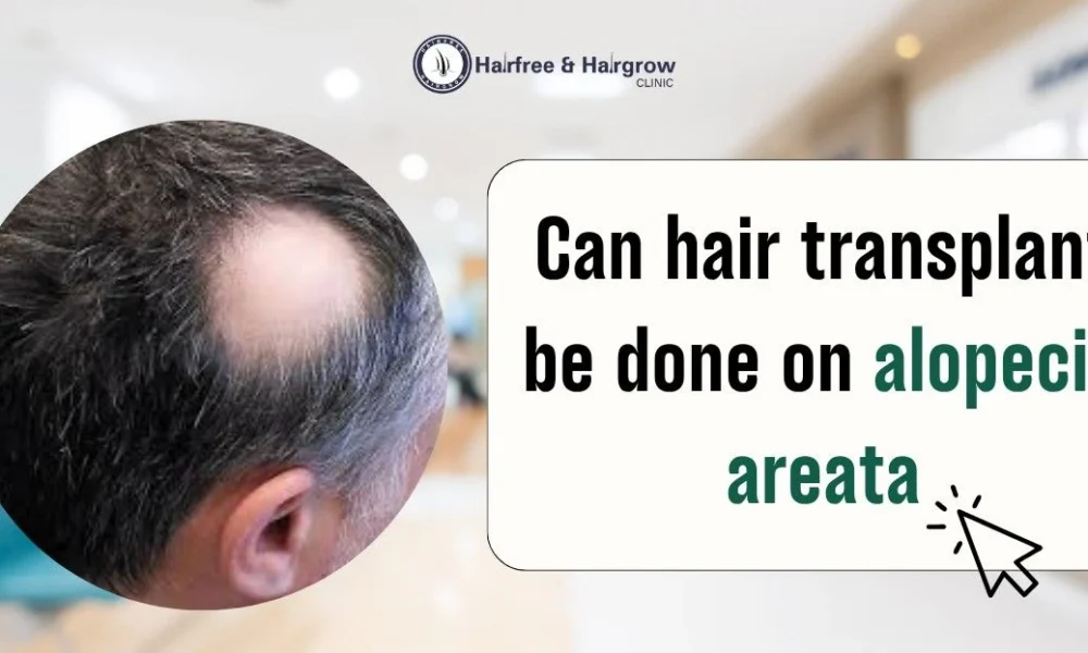 can-hair-transplant-be-done-on-alopecia-areata